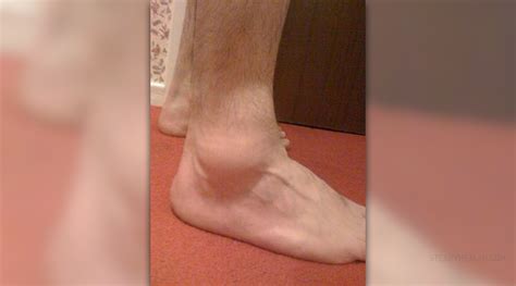 What to do for swollen ankles | General center | SteadyHealth.com