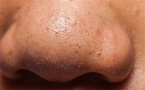 Blackheads on Nose: Causes, Remedies, and Prevention Tips - The Derm Spot