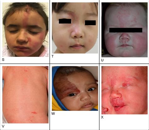 Nevus Simplex vs Nevus Flammeus: Do You Know Which is Which? | Brown ...