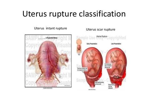 Ruptured Uterus Pictures - PictureMeta