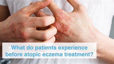 What do patients experience before atopic eczema treatment by our ...