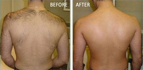 Laser Hair Removal – The Premier Aesthetic