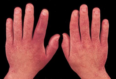 Figure 1 from Papular purpuric rash due to parvovirus B19 with distribution on the distal ...