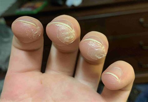 Guitar Calluses Explained: What, Why and How - Guitar Inside Out