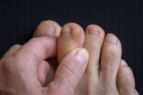 What Causes Blisters on the Toes? (2022)