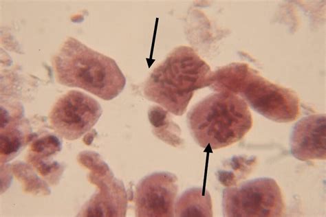 Cell showing sticky metaphase with precocious movement of chromosome | Download Scientific Diagram