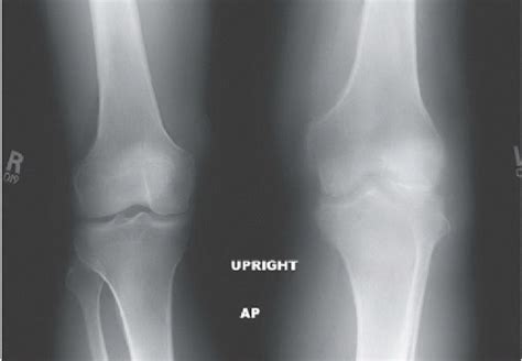 Septic Arthritis (Knee) | Radiology Key