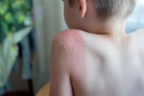 How to Treat Your Child’s Sunburn - Frisco Pediatrician Entirely Kids Pediatrics