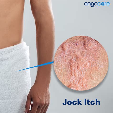 Jock Itch: Symptoms, Causes, Diagnosis, Treatment