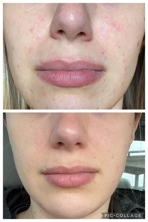 Using azelaic acid twice a day has made the biggest difference! : r/Rosacea