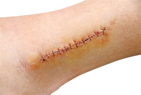 When Does a Cut Need Stitches? | Complete Care