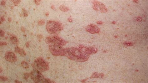 Images Of Lupus Skin Rash Google Search Circular Skin - vrogue.co