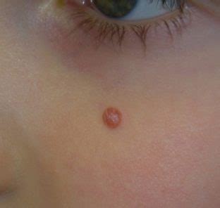 Spitz nevus - Dermatology Advisor