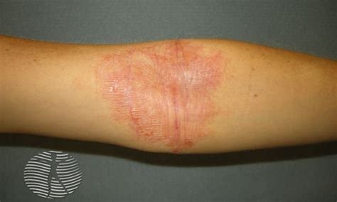 Atopic eczema | NHS inform