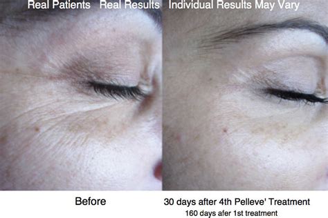 Pelleve Results in Atlanta, GA | Sculpted Contours