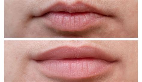 Botox Lip Flip Before and After: What is a Lip Flip and Who Needs It? - Ostomy Lifestyle