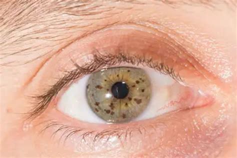 What Is Nevus (Eye Freckle)? - Eye Conditions - The Eye News