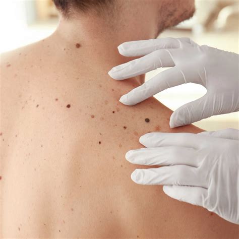 Mole Removal - Unique Dermatology and Spa