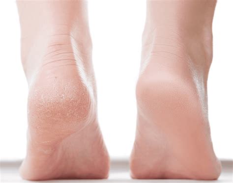 What Really Causes Cracked Heels and How to Heal Them (Part I): Gotham Footcare: Podiatrists