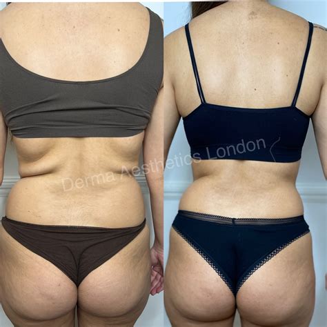 Cryolipolysis | Derma Aesthetics London