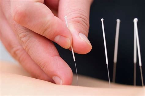 Motor Point Acupuncture for Muscle Weakness | Acupuncturist