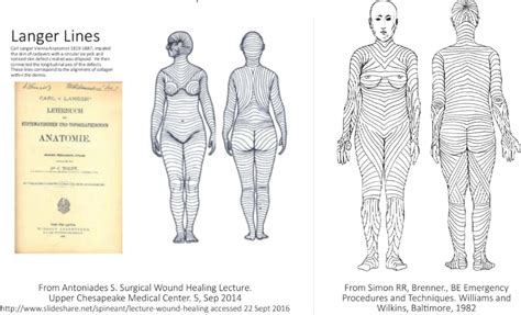 The location of the scar for hip replacement surgery is changing for the better! - Hip ...