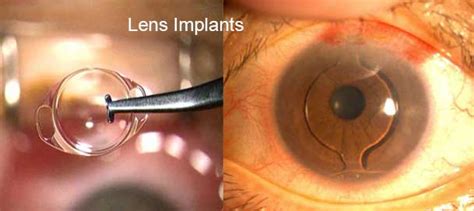 Intraocular Lens | IOL Implants : Lens Replacement After Cataract Surgery