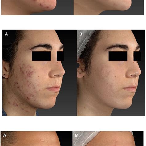 | Nodulocystic acne before (A) and after (B) 4 sessions of IPL ...