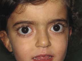 Photograph of the patient showing exophthalmia | Download Scientific Diagram