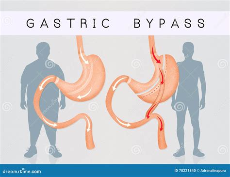 Before and after Gastric Bypass Surgery Stock Illustration - Illustration of care, diet: 78221840