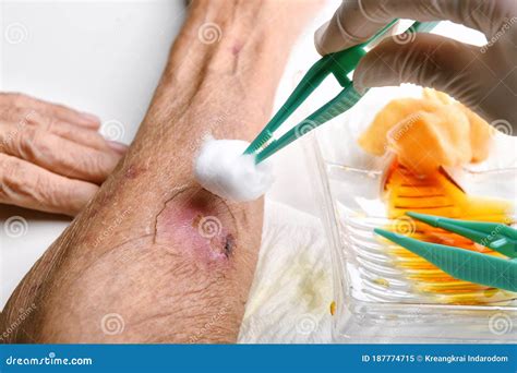 Wound Dressing, Doctor Cleaning And Wash Infected Wound In Chronic Diabetes Senior Patient With ...