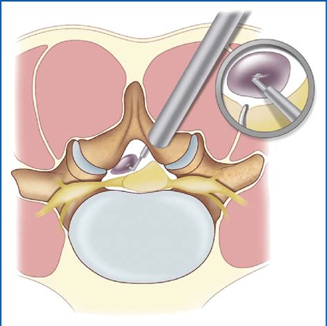 Synovial Cyst With Spinal Stenosis Synovial Cyst With Spinal Stenosis ...