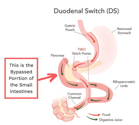 Duodenal Switch Surgery, Is It Better Than VSG and Bypass?