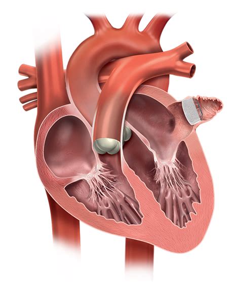 About the Procedure | WATCHMAN Device