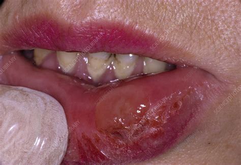 Syphilis ulcer on lower lip - Stock Image - C054/6405 - Science Photo ...