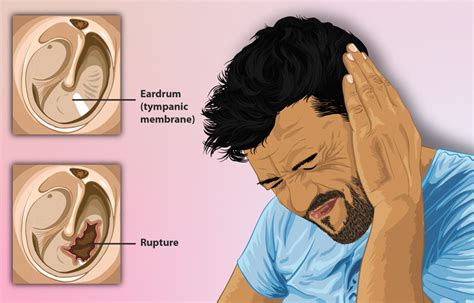 Retracted Eardrum Causes, Symptoms, Causes, Treatment, 54% OFF