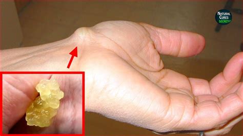 Ganglion Cysts Best Home Remedies - Hard Lump on Wrist Removal - YouTube