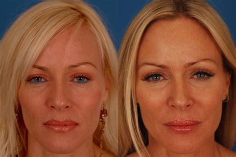 Photo Set Botox Injectables Fillers Plastic Surgery | My XXX Hot Girl