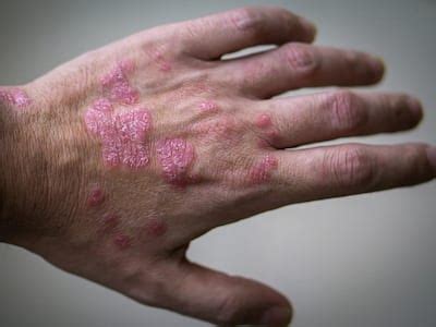 Psoriasis: Causes, Triggers, Treatment, and More | TheHealthSite.com