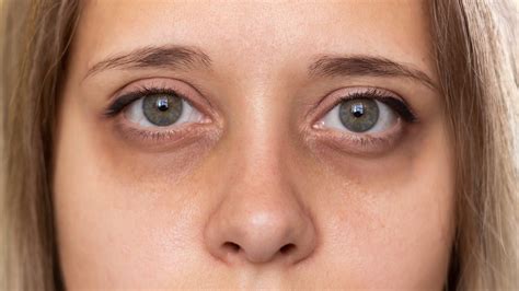 Dermatochalasis Unraveled: From Definition to Treatment of ‘Baggy Eyes ...