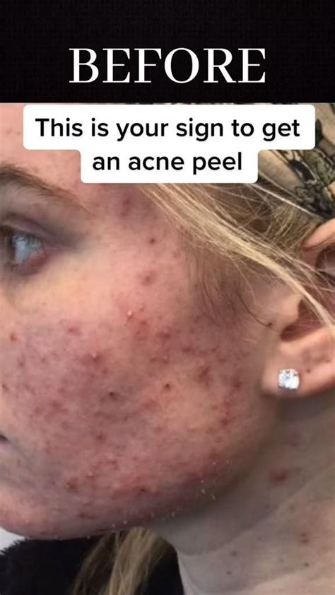 This is your sign to get an Acne Peel | Acne peel, Spots on face, Skin