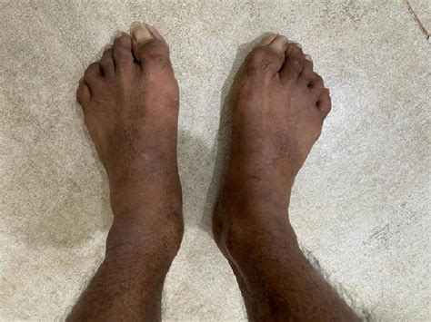 Hallux valgus deformity due to foot involvement in diabetic... | Download Scientific Diagram