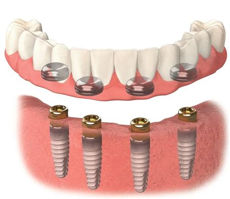 Snap-In Dental Implants | Snap-On Denture Implants