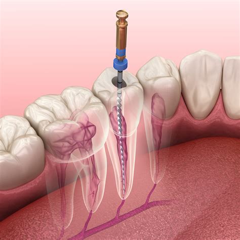 Root Canal Therapy – Maple Ridge Endodontics