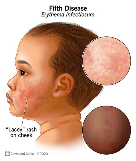 Fifth Disease (Erythema Infectiosum): Symptoms, Causes & Treatment