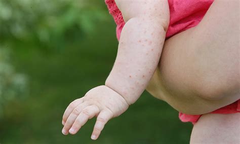 Baby Heat Rash: Symptoms, Prevention and Treatment | Pampers