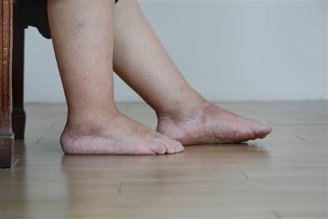 Swollen Ankles Stock Photos, Pictures & Royalty-Free Images - iStock