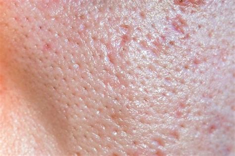 Reducing Large Pores: The Best Tips and Tricks | Large pores, Deep pore cleanser, Skin textures