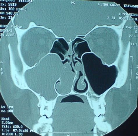 Killian's Antro Choanal Polyp