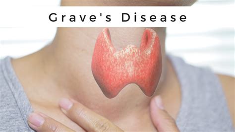 Graves Disease: Hyperthyroidism - Complete Overview